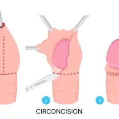 Étapes de la circoncision, une pratique importante dans la fête de la circoncision islamique.