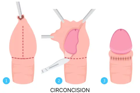 Étapes de la circoncision, une pratique importante dans la fête de la circoncision islamique.