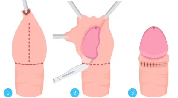 Étapes de la circoncision, une pratique importante dans la fête de la circoncision islamique.