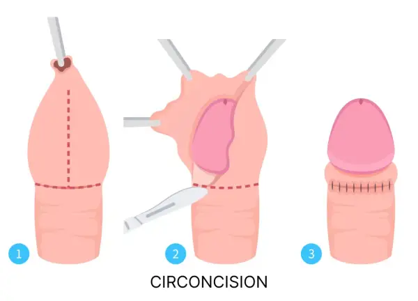 Étapes de la circoncision, une pratique importante dans la fête de la circoncision islamique.